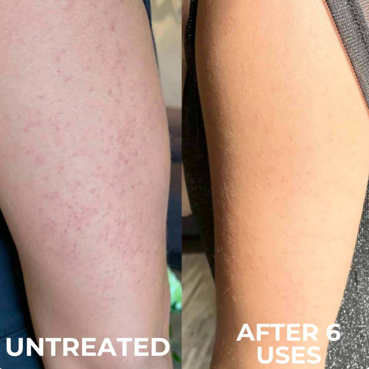 Keratosis Pilaris Resurfacing Cream