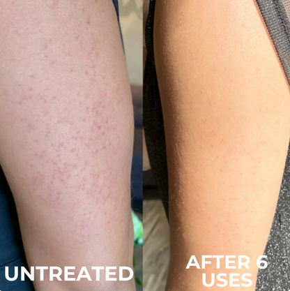 Keratosis Pilaris Resurfacing Cream