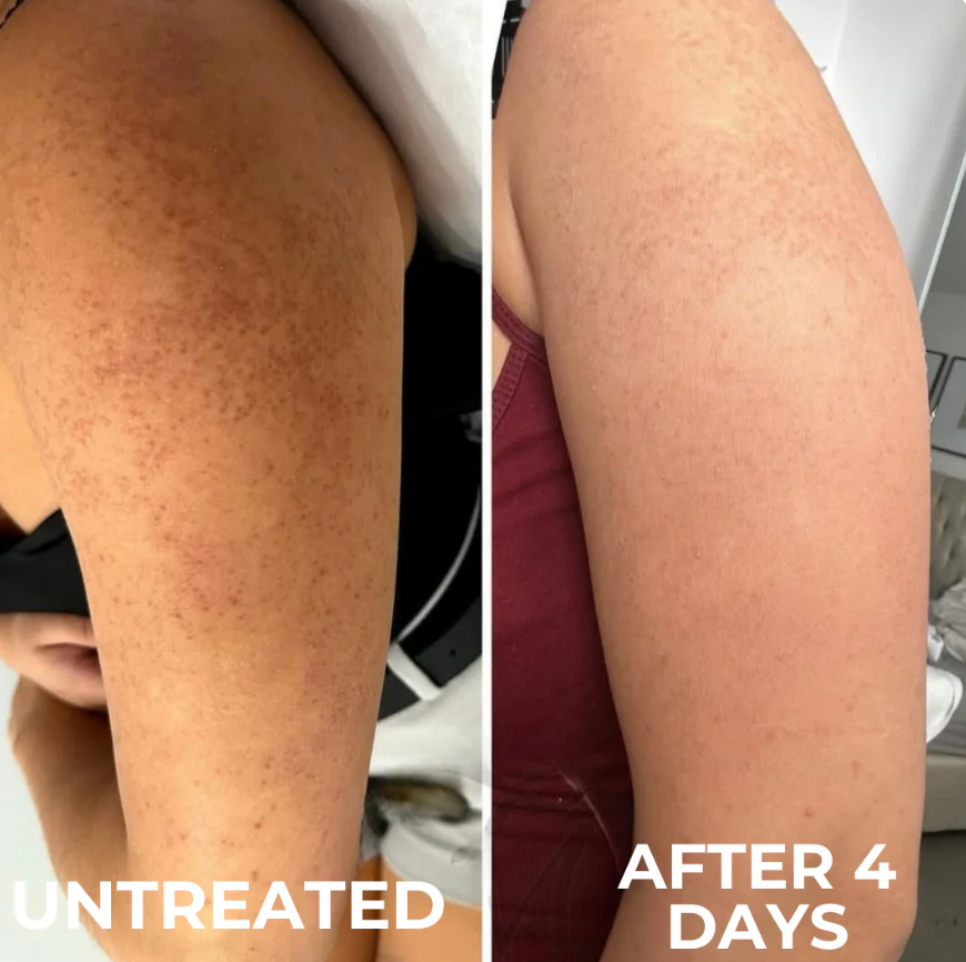 Keratosis Pilaris Resurfacing Cream