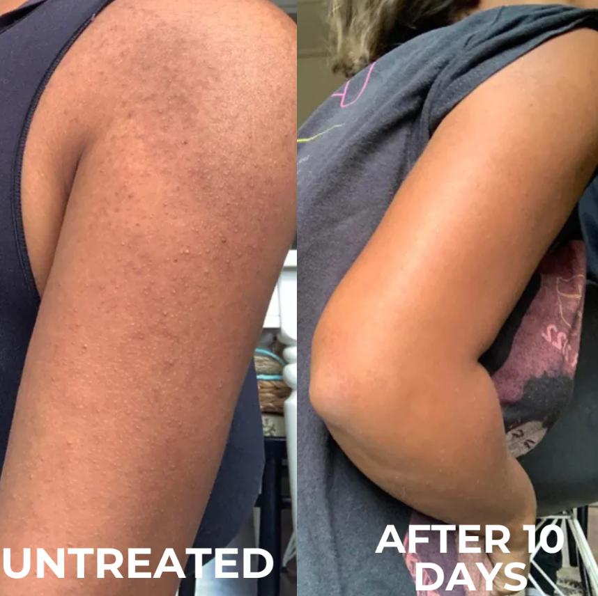 Keratosis Pilaris Resurfacing Cream