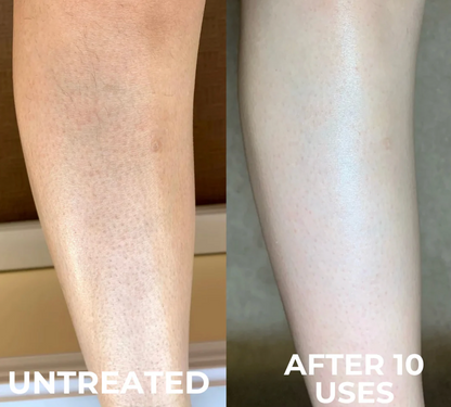 Keratosis Pilaris Resurfacing Cream